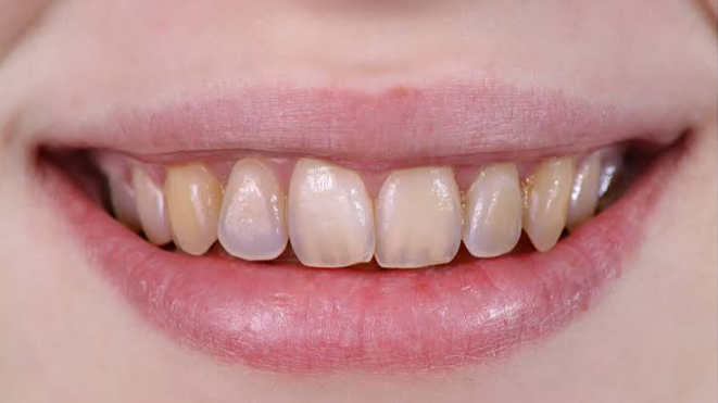 What Weak Or Brittle Teeth Can Reveal About Enamel Development